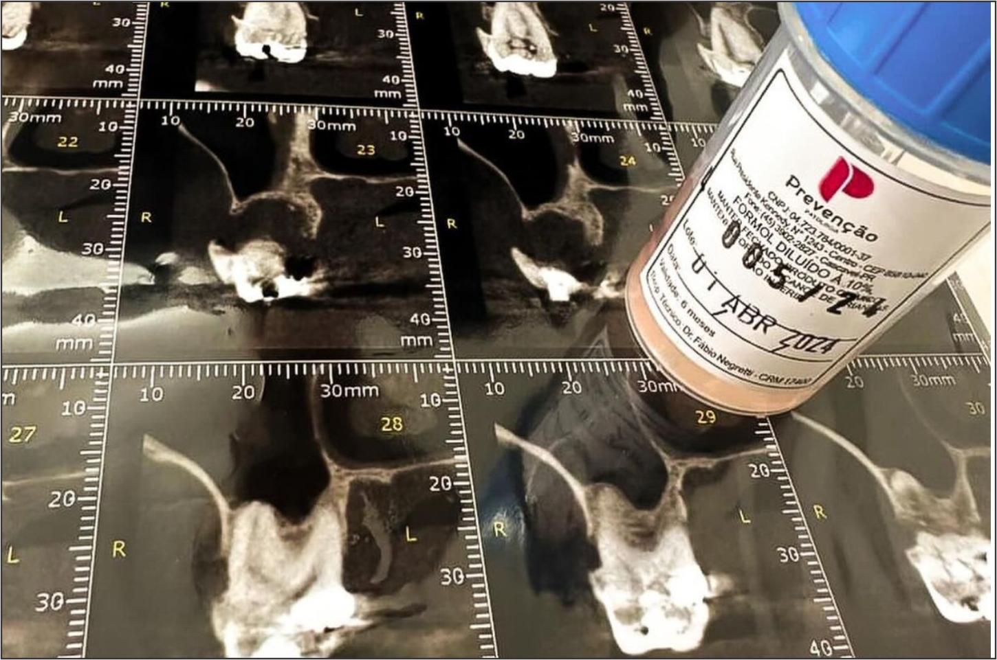Dra. Caroline Beltramin: Biópsia em Odontologia - Detectando e Diagnosticando Lesões Bucais.