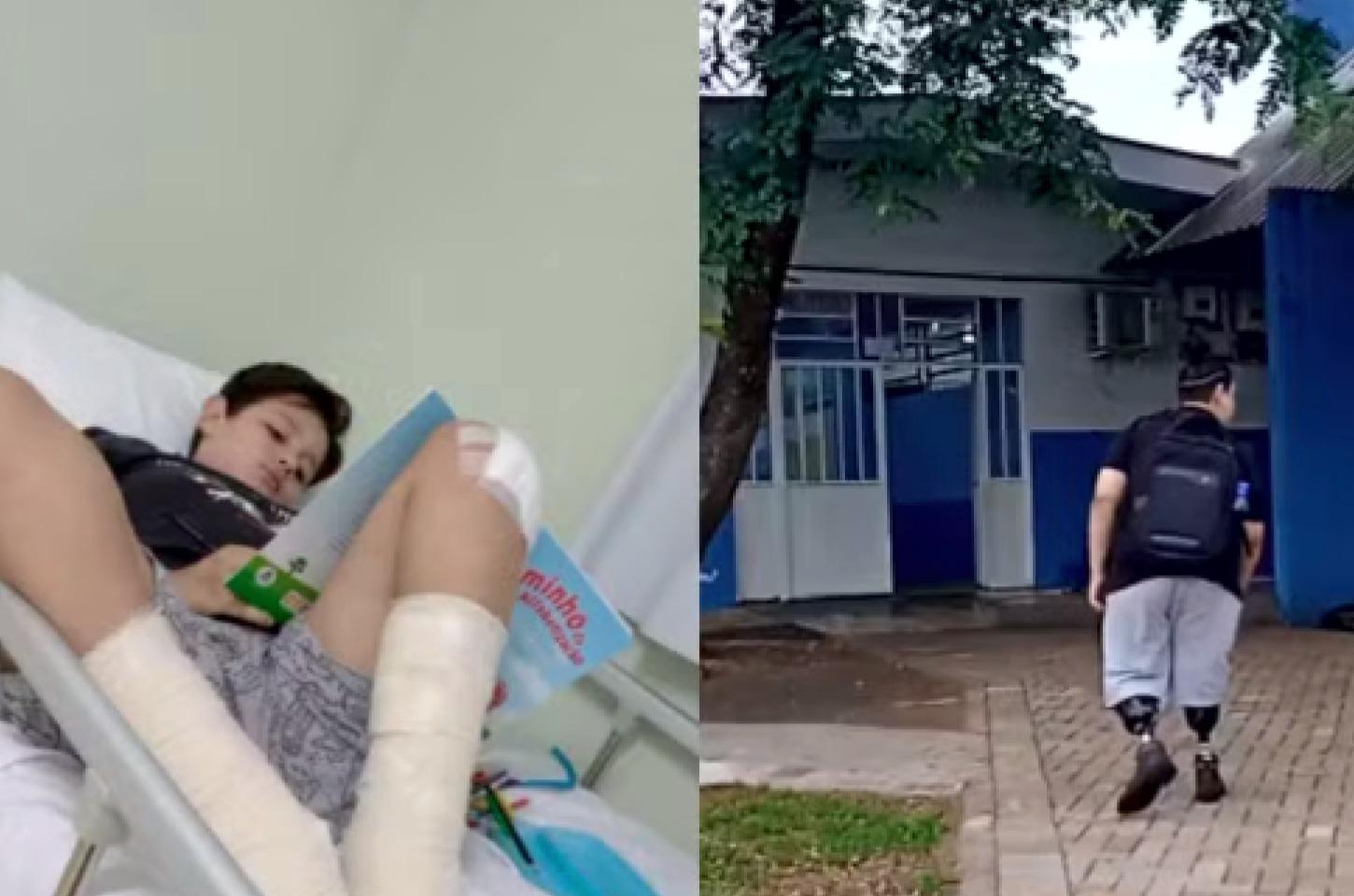 Criança de 10 anos enfrenta infecção grave após queda de skate, perde as pernas e transforma dor em inspiração