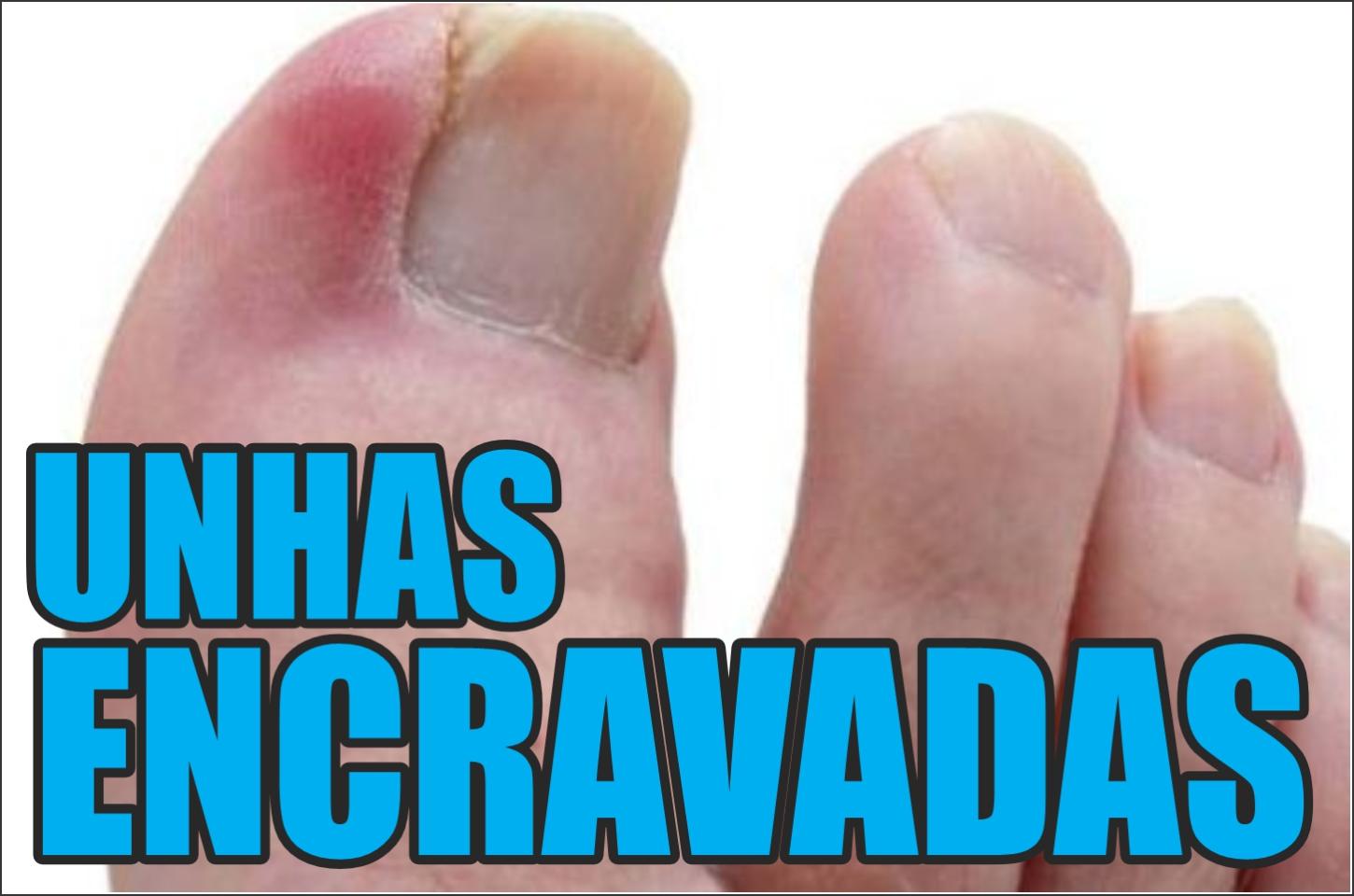 Vamos falar sobre a ONICOCRIPTOSE (UNHA ENCRAVADA)