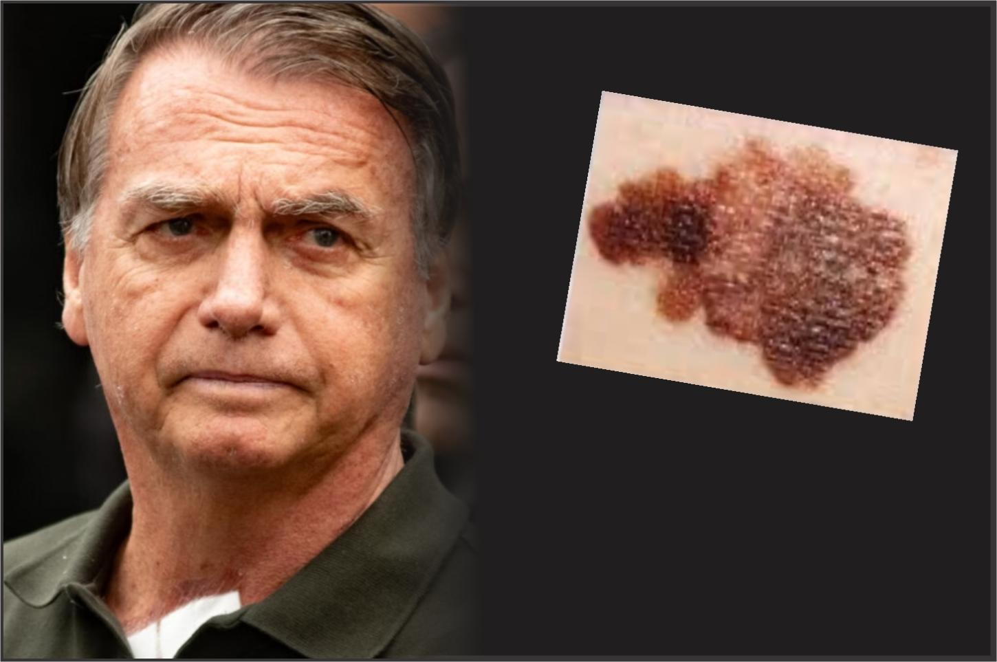Exames apontam câncer de pele em Bolsonaro, diz médico