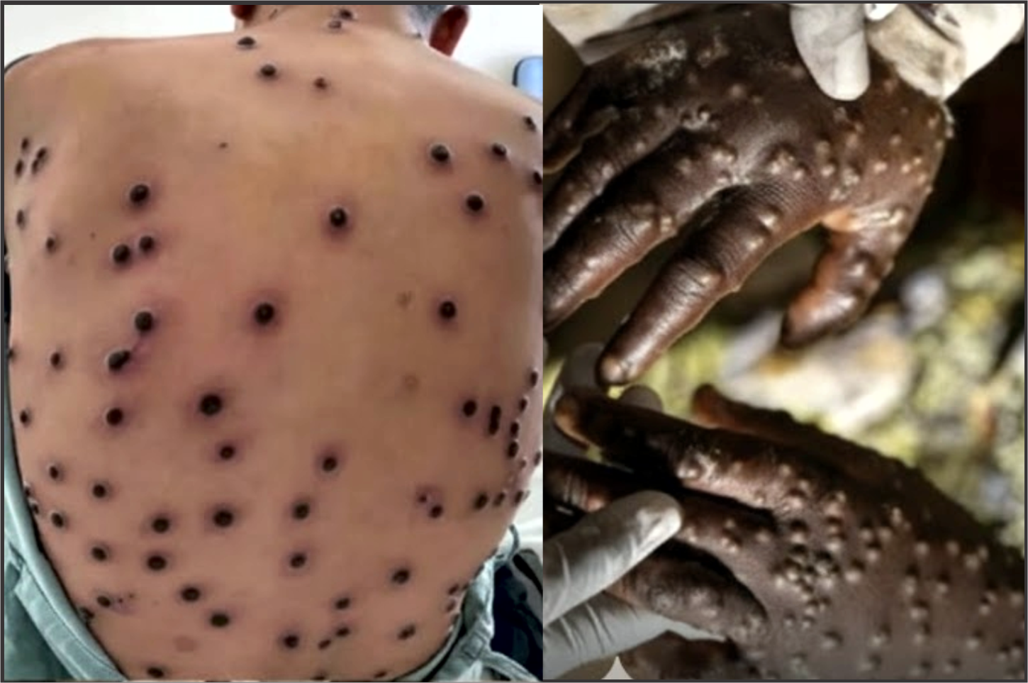 Após o Carnaval, Brasil registra novos casos de mpox e autoridades reforçam alerta à população