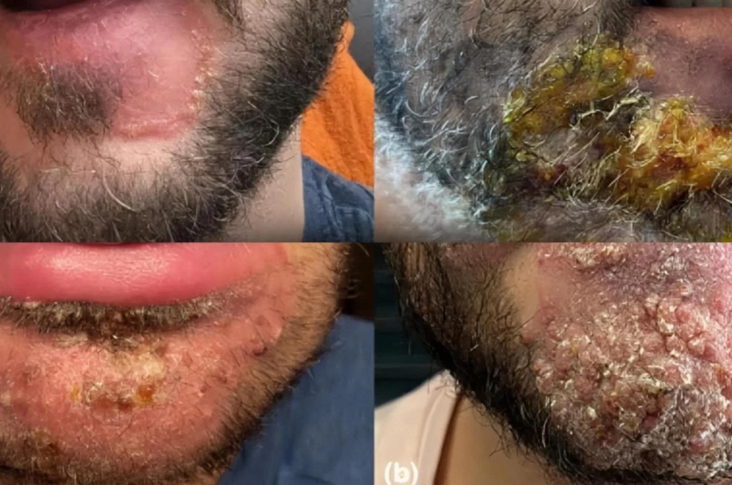 Estados Unidos registram maior surto de fungo sexualmente transmissível e emitem alerta no país