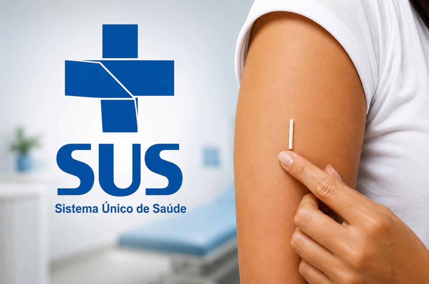 Implante contraceptivo Implanon passa a ser oferecido gratuitamente pelo SUS